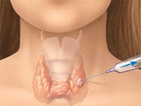 imagine cu noduli tiroidieni